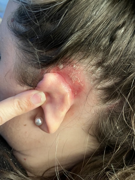 A thread for those with psoriatic arthritis?