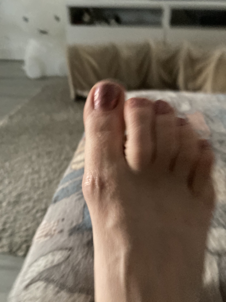 How can I stop this bunion getting worse? (Photo)