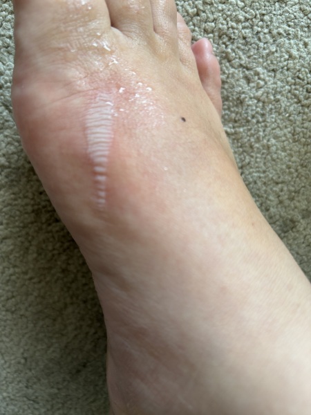 Straightener burn