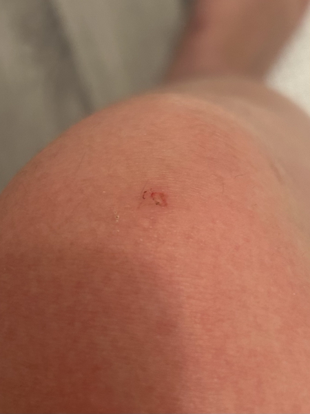 Do I need A&E for this?