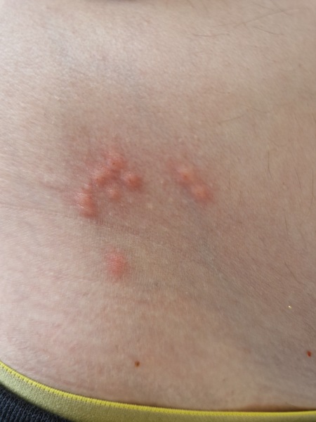 Anyone recognise this rash?