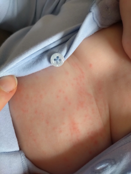 Is this eczema or something else?