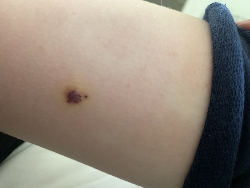 Any idea what this is on son's leg?