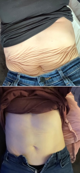 Is 15 st too heavy to come back from??