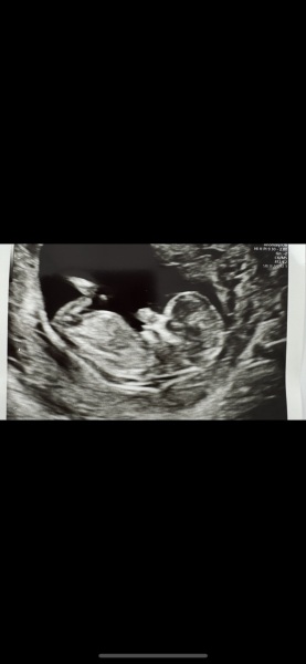 Boy or girl 12 week scan!