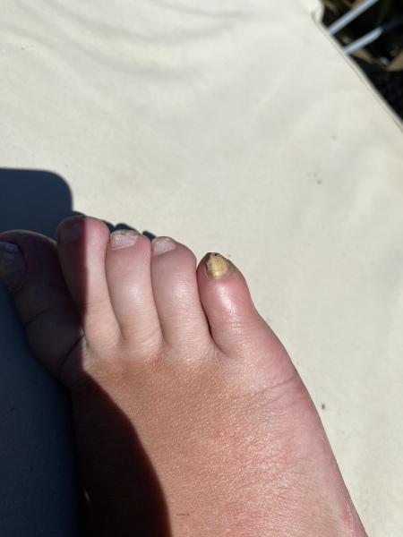 What the hell have I done to my toe- gross picture alert!