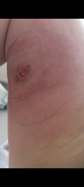 Infected insect bite!!