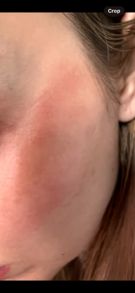 Eczema/Allergies/Diet/HRT/getting older ?