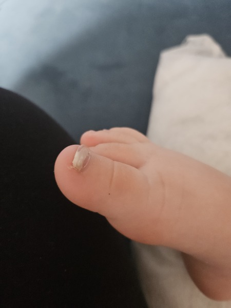 Toddlers big toe nails look weird.