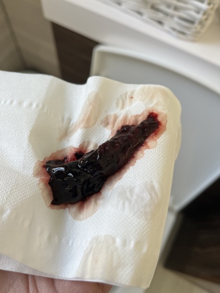 Passed a clot 11 days PP - normal? TMI pic