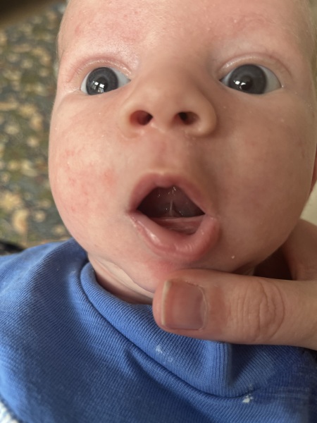 Tongue Tie?