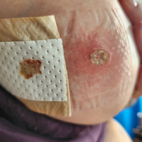 Sore spot on breast. Doctor or wait and see?
