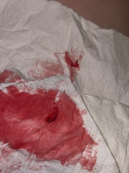 Possible chemical pregnancy (picture attached) TMI