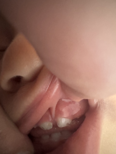 Problem with my one year olds teeth