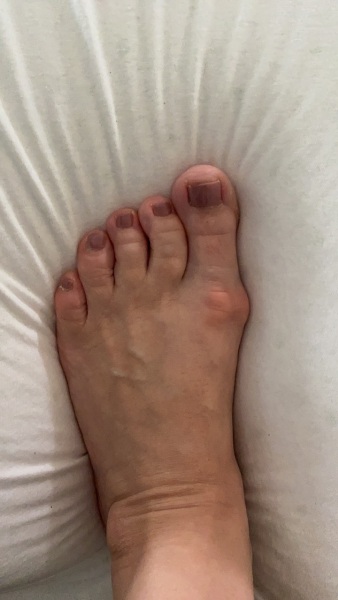 How can I stop this bunion getting worse? (Photo)