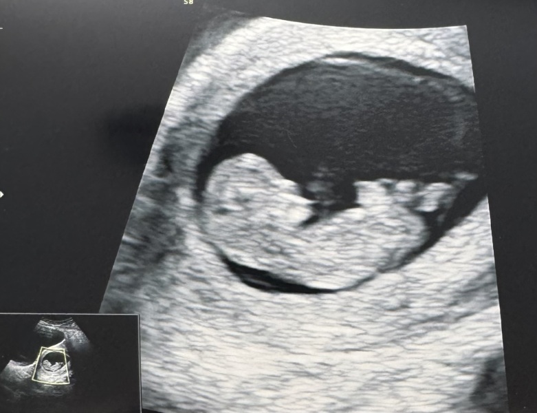 TTC after chemical - anyone with me?