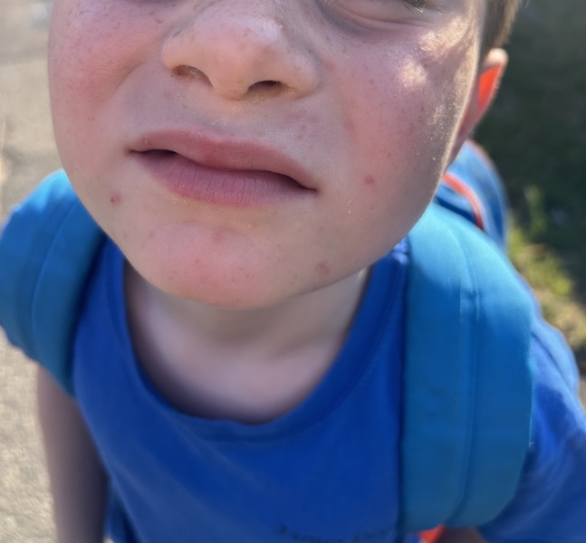 Does this look like pox/heatrash?