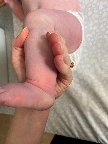 Fingers / toes randomly go red and swell