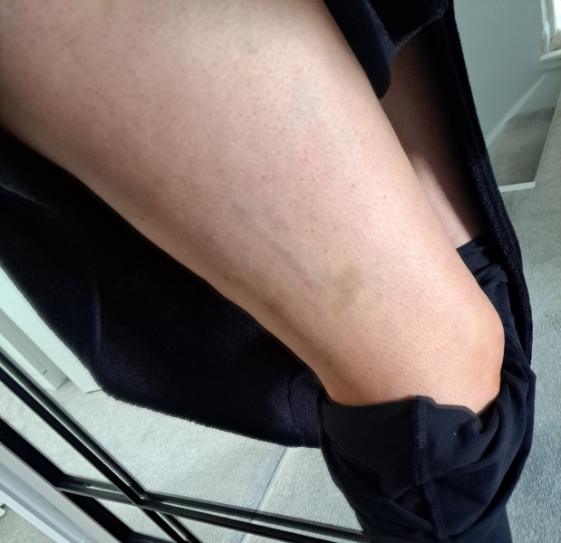 Huge bruises on legs for 3 weeks... what's going on?!