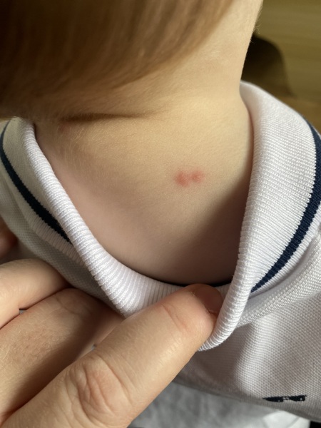Spots not chicken pox