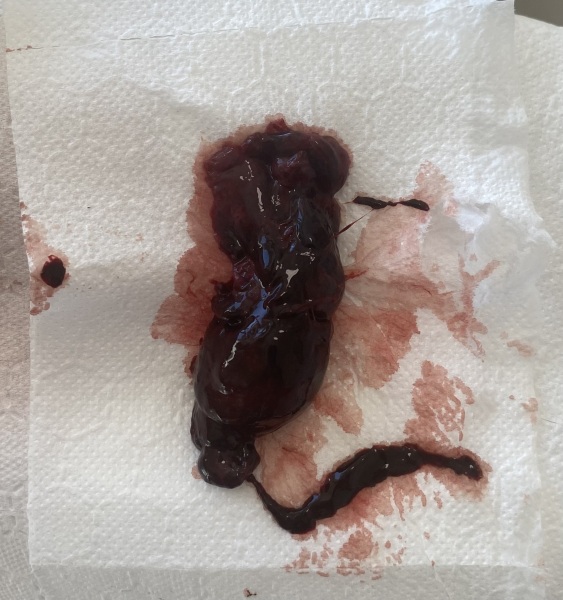 Ladies please help trigger warning blood clot.