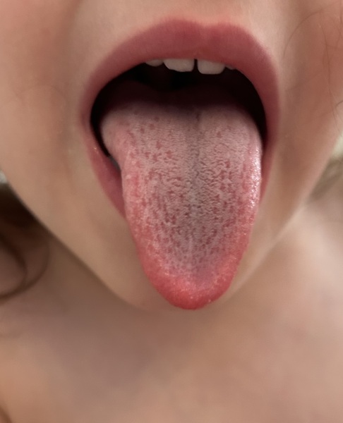 Help is this strawberry tongue ?