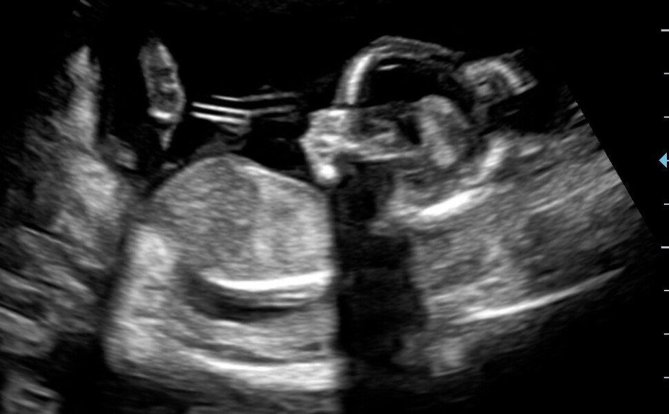 BFP after recent loss