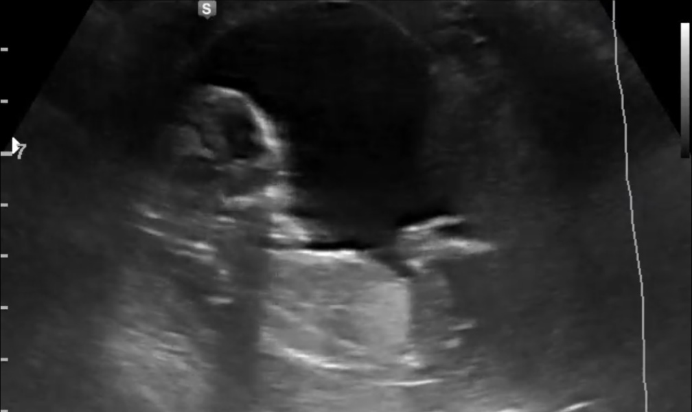 Nub / Gender - Ultrasound Tech wouldn’t commit! Opinions?