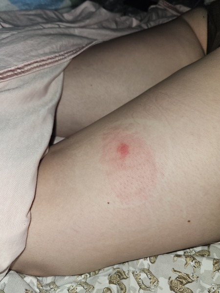 Horse fly bites? Photo