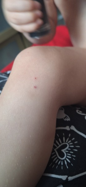 What is this mark on my 4 year old?