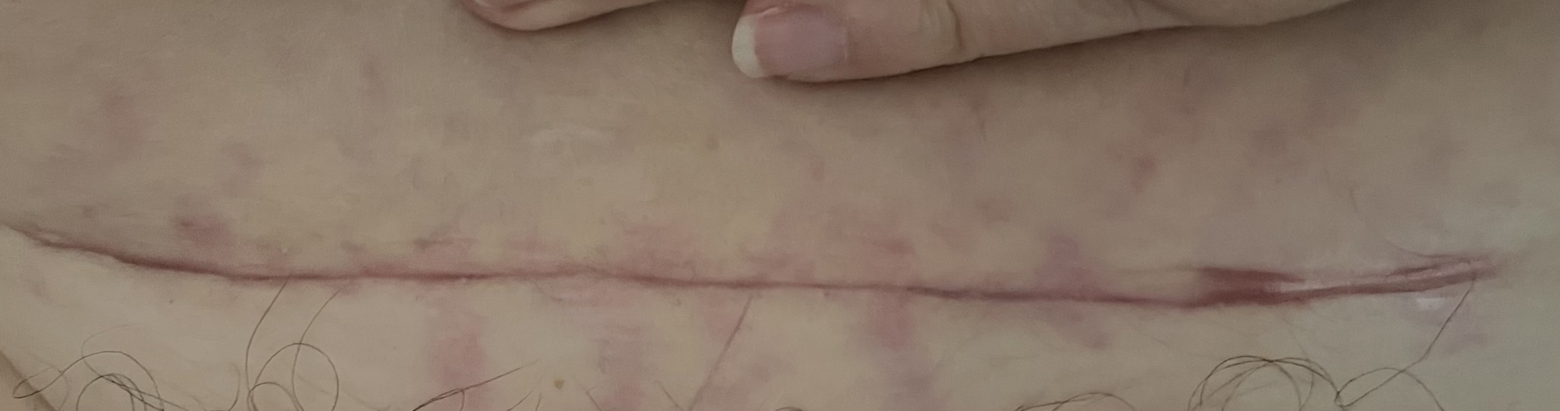 C section infection not clearing after 4 rounds of antibiotics!