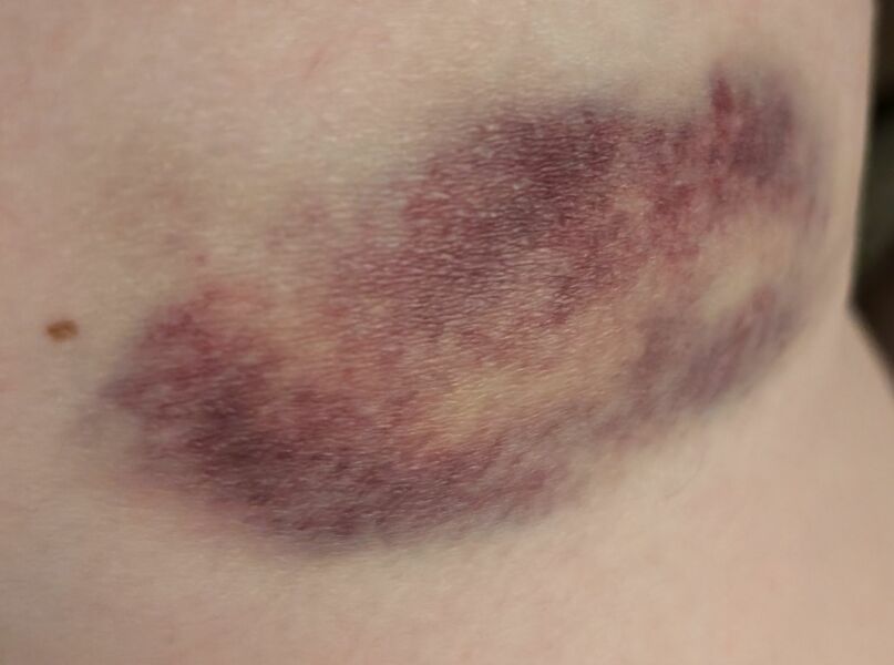 To not see the GP? Popped vein? Pic added