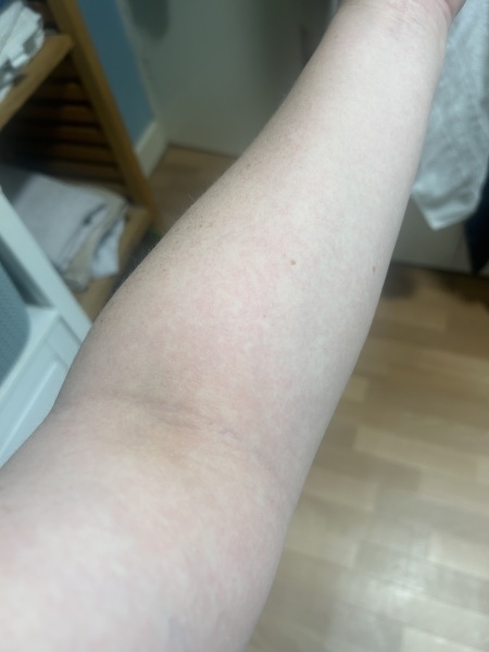 Scared woken up with this rash all over me