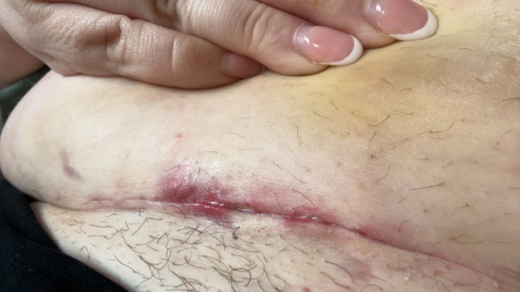 C section *MNHQ adding content warning for corresponding photo*