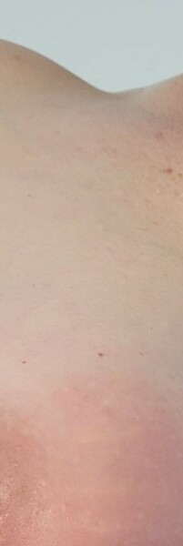 Scared it might be inflammatory breast cancer