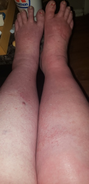 Is this cellulitis?