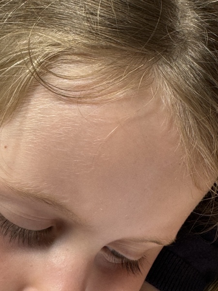 Severe chicken pox help!