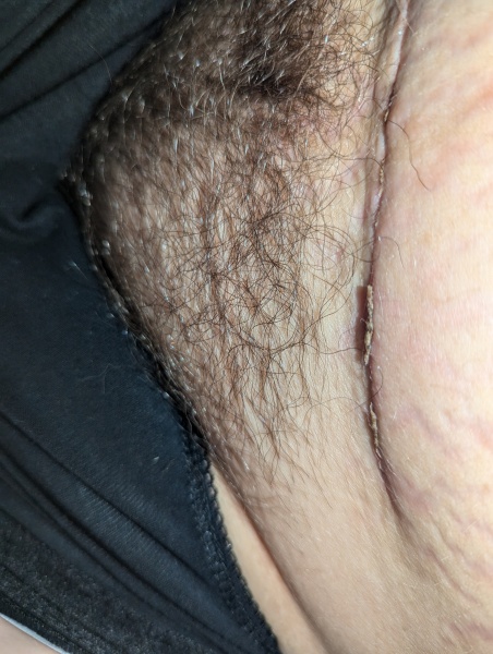 C-section incision has lumpy bits sticking out?