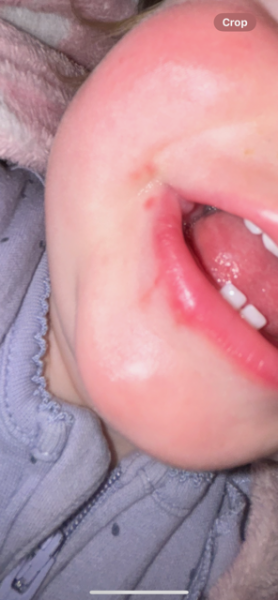 Coldsores or drool rash