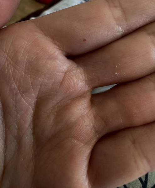 Normal mole?? Underside of finger