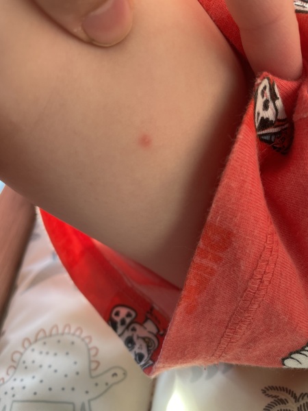 HFMD or chickenpox?