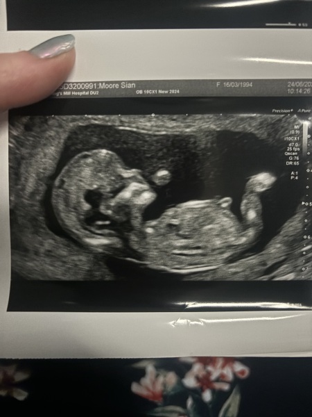 Nub theory for 12 week + 5 days