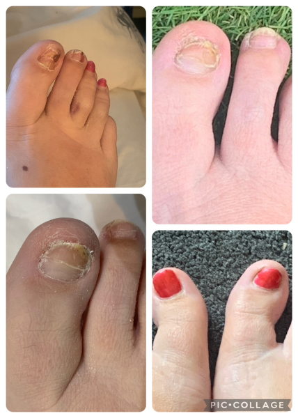 Broken toe, nail about to come off!