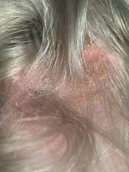 Psoriasis