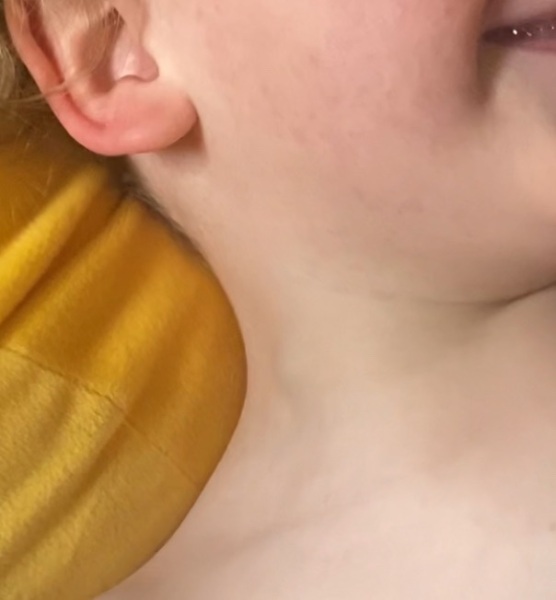 Lump in 2yo neck