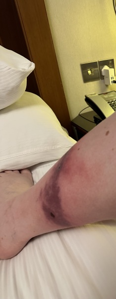 Talk to me about mosquito bites/hives