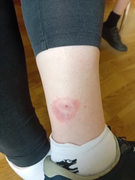Bite