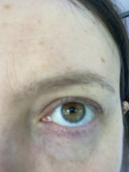 Kaleidoscope vision / blackLine around pupil