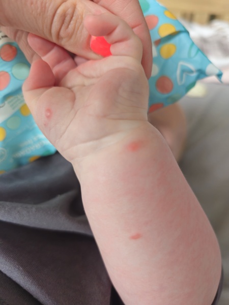 Spots on baby