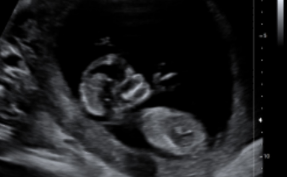 12 week scan - nub/ skull theory 